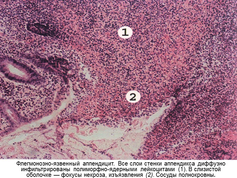 Флегмонозно-язвенный аппендицит. Все слои стенки аппендикса диффузно инфильтрированы полиморфно-ядерными лейкоцитами (1). В слизистой оболочке